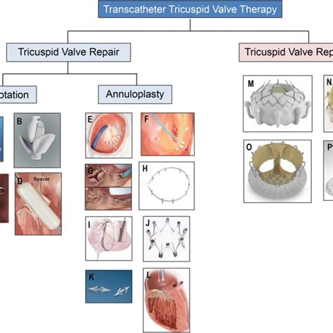 Transcatheter Tricuspid Valve Therapies Transcatheter Tricuspid Valve