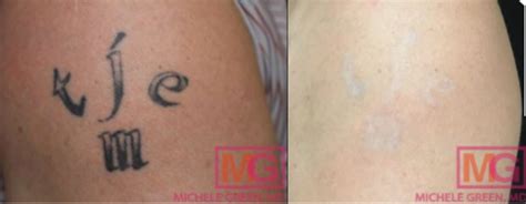 Picosure Laser Treatments Tattoo Removal Acne Scars And Melasma Dr