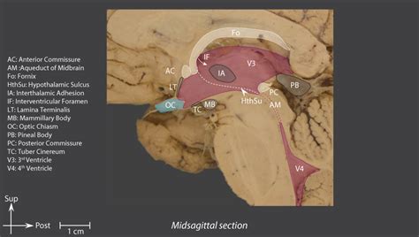 Third Ventricle Brain Inter Atlas