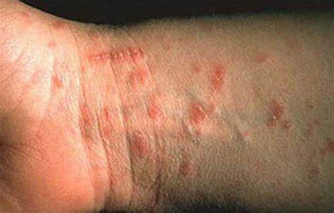Scabies Infestation Rash Pictures Atlas Of Rashes Associated With Fever
