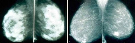 Clues Inside The Younger Breast