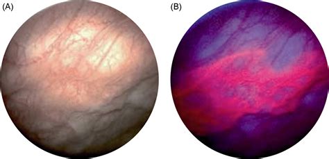 Hexaminolevulinate Guided Fluorescence Cystoscopy In The Diagnosis And