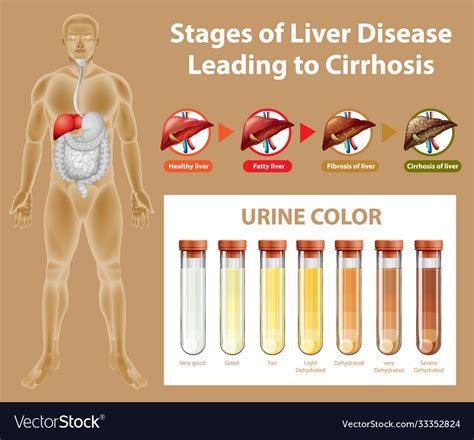 Stages Liver Disease Leading To Cirrhosis Vector Image