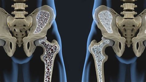 Osteoporosis Your First Fracture Is An Emergency Do Not Have A