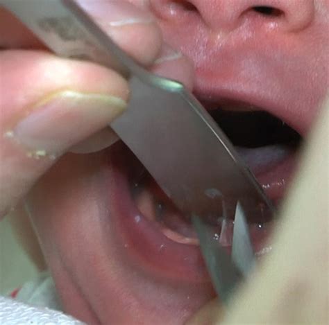 Frenotomy For Tongue‐tie Frenulum Linguae Breve Showed Improved Symptoms In The Short‐ And
