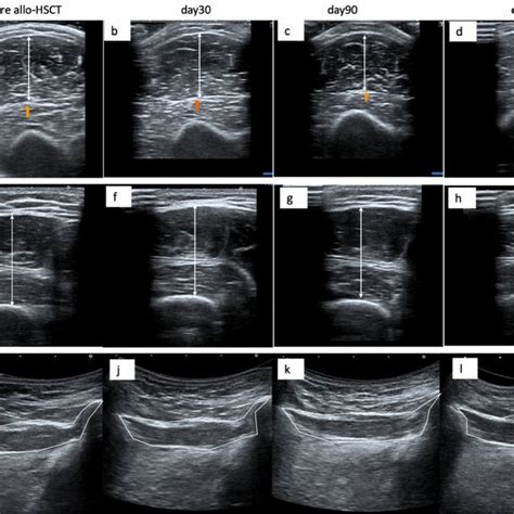 Ultrasound Images Of The Biceps Muscle Ad The Vastus Intermedius