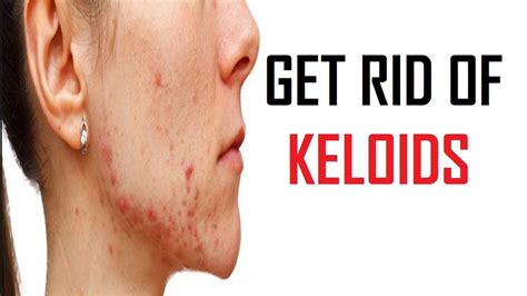 7 Best Remedies To Get Rid Of Keloids Youtube