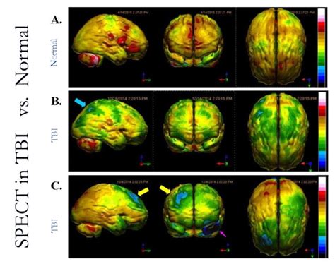 Advanced Neuroimaging Can Guide Interventions In Traumatic Brain Injury