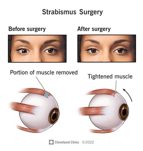 Strabismus Surgery Procedure Details And Recovery