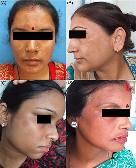 Clinical Types Of Melasma And Facial Pigmentary Demarcation Line