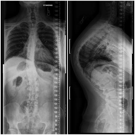 Ive Got Both Scoliosis And Scheuermanns Disease These Are From
