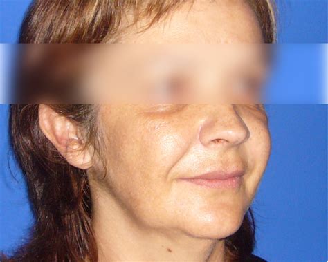 Lifting Facial En La Mejor Clínica De Madrid Dr Sarmentero