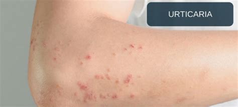 Urticaria An Overview Hashmi Dawakhana