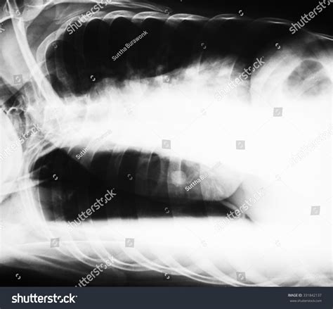 Chest Xray Image Right Lateral Decubitus Stock Photo 331842137