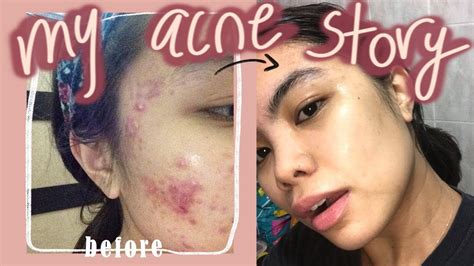 How I Cleared My Skin My Acne Journey How I Got Rid Of My Acne