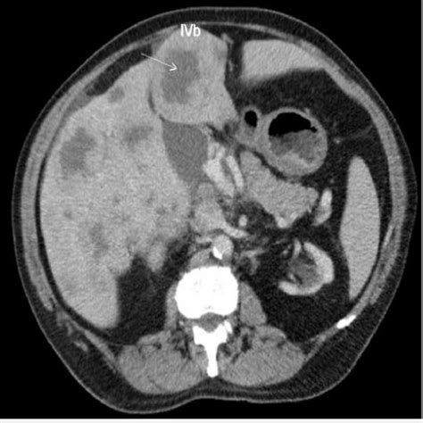 Ct Cross Sectional View Of The Abdomen Shows Widespread Metastasis Of