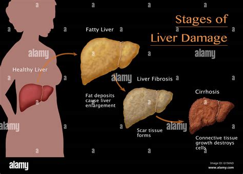 Stages Of Liver Damage Liver Disease Healthy Fatty Liver Fibrosis And