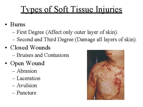 Soft Tissue Injuries What Are Soft Tissues Soft