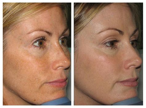 Before And After Renova Laser Hair Removal And Medspa Houston Tx