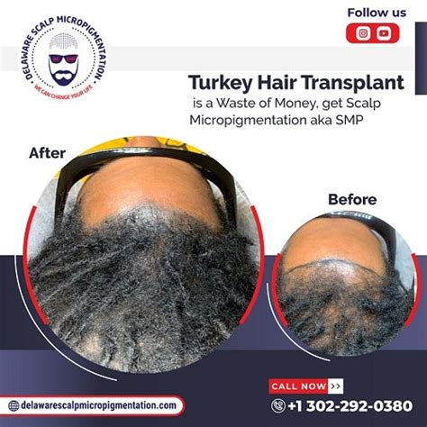 Turkey Hair Transplant Is A Waste Of Money Get Scalp Micropigmentation