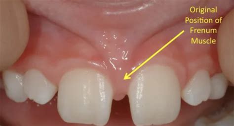Frenectomy South Jersey Periodontics And Dental Implants