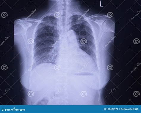 Soft And Blurry X Ray Chest Reticular Infiltration At Right Lobe