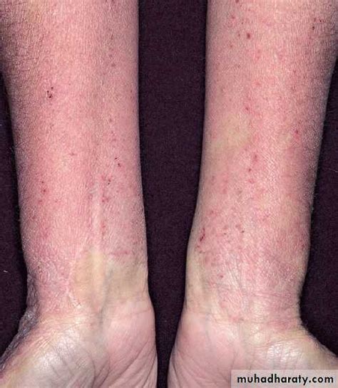 Endogenous Eczema Pptx دمنار Muhadharaty
