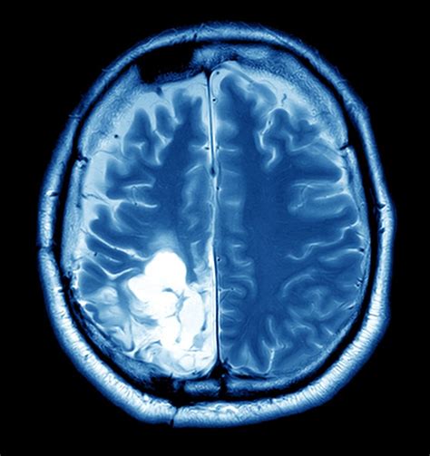 Brain Tumor Guide Causes Symptoms And Treatment Options