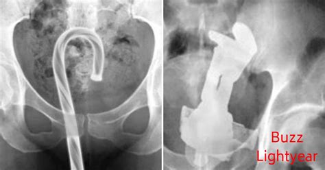 Very Unusual Objects Stuck Inside Peoples Orifices That Required Er