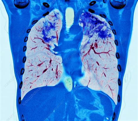 Pulmonary Sarcoidosis Ct Scan Stock Image C0372871 Science