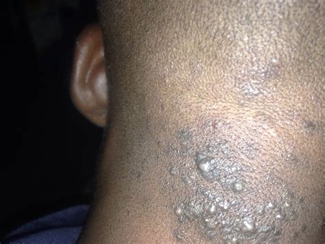 Please Help Bumps At The Back Of Head Health Nigeria