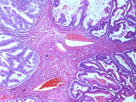 Borderline Epithelial Tumors Of The Ovary Intechopen