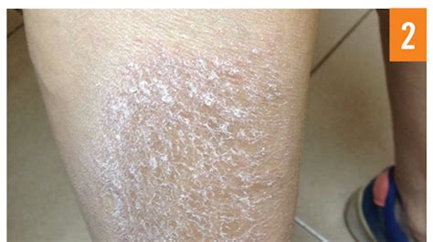 65 Year Old Female With Pruritic Dry Scaly Skin On Lower Legs The