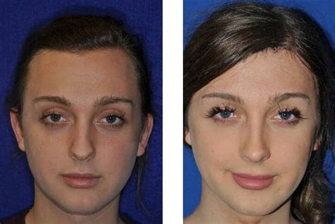 Facial Feminization Surgery Pictures Telegraph