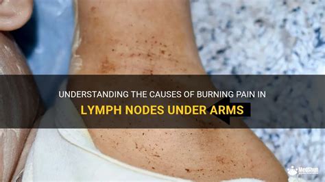 Understanding The Causes Of Burning Pain In Lymph Nodes Under Arms