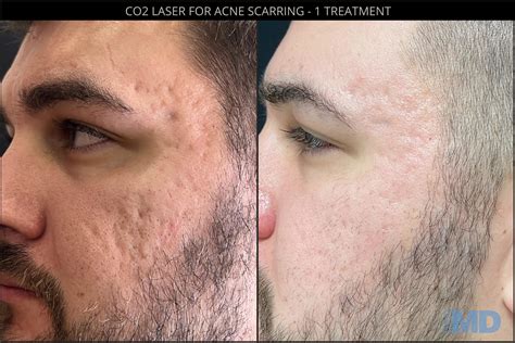 Co2re® Laser Resurfacing Boston Skin Md