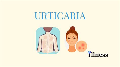 Urticaria Hives Overview Causes Symptoms Treatment
