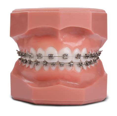 The Complete Guide To Self Ligating Braces Premier Orthodontics