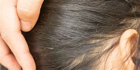 How To Tell The Difference Between Lice And Dandruff