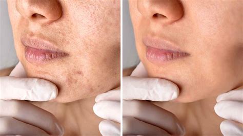 Does Tretinoin Help With Acne Scars Benefits And Risks