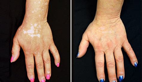 For Vitiligo Patient Arthritis Drug Restores Skin Color Yalenews