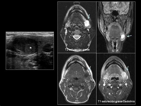 Comparación entre la morfología y evolución (conducto biológico) del adenoma pleomorfo con las neoplasias malignas de las. Adenoma pleomorfo en la glándula submaxilar izquierda. La ...