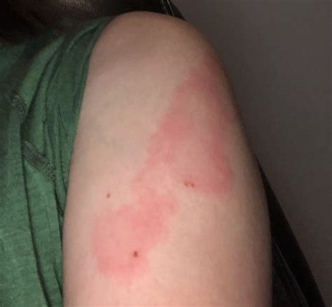 Rare Covid Arm Side Effect Leaves People With Red Lumps After Getting