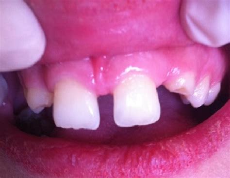 Intra Oral View Showing Preoperative Giniva And Labial Frenum