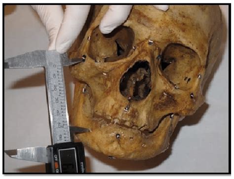 A Photograph Showing Direct Linear Measurement From Right Zygomatic