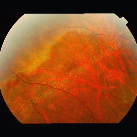 White Retina