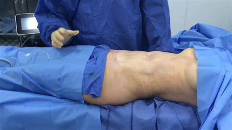 From Deformed Abdomen To Smooth Abdomen With Dr Hughes Part Youtube