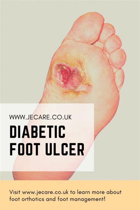 Diabetic Foot Ulcers Diagnosis Je Care And Consultants Ltd