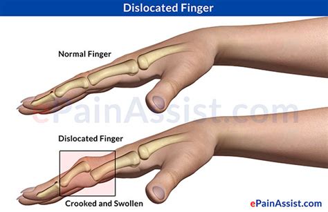 dislocated finger types causes symptoms treatment metal implants exercises