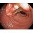 Colon Cancer Endoscope View  Stock Image C019/4508 Science Photo